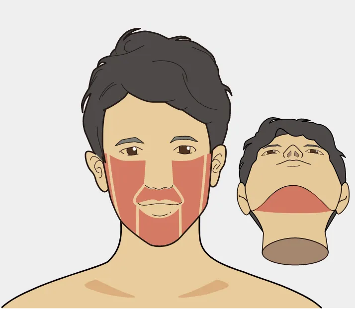 ヒゲ脱毛５部位　アイキャッチ画像