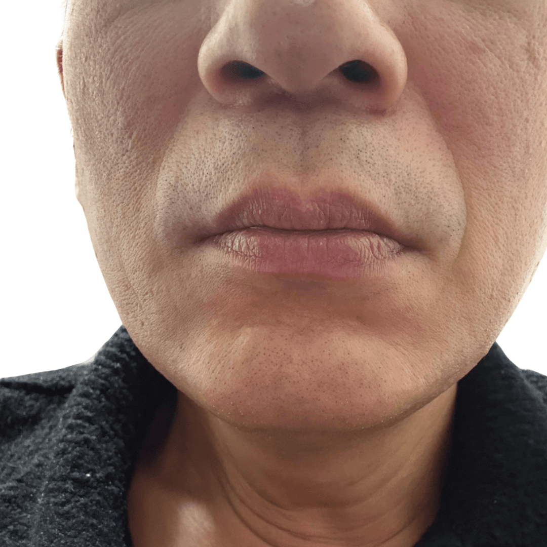 6回目　施術後画像